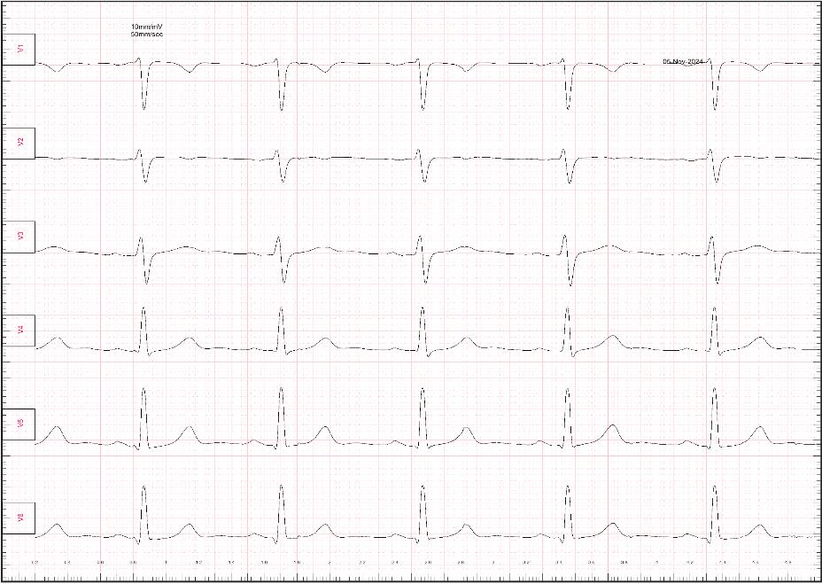 Registro ECG de 12 derivaciones en papel milimetrado